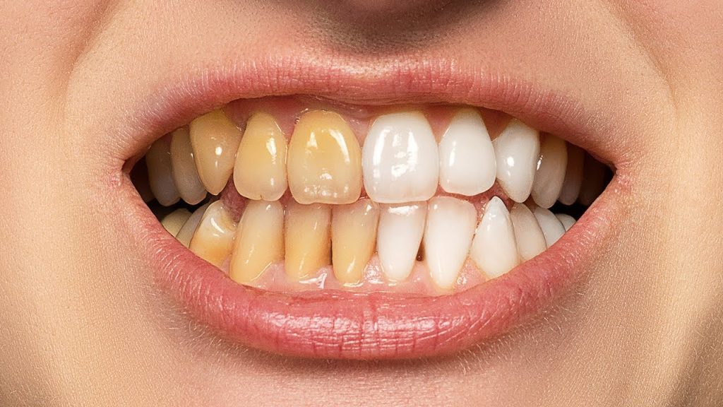 Reasons Why You Should Get Your Teeth Whitened